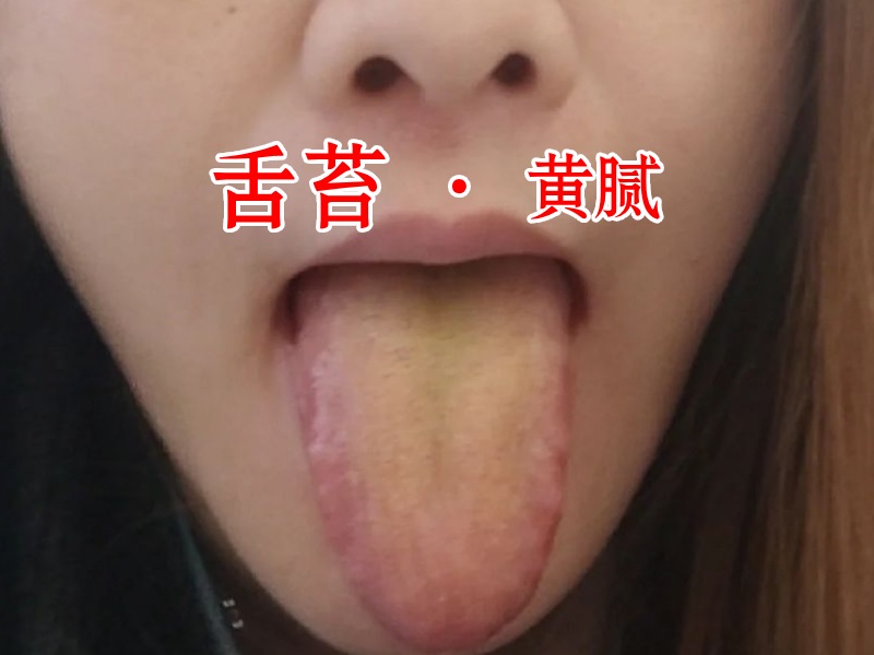 舌苔照片1